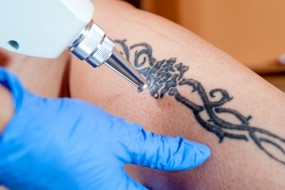 Usuwanie tatuażu, makijażu permanentnego