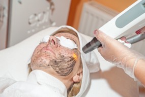 Laserowy Peeling węglowy - laser Nd Yag