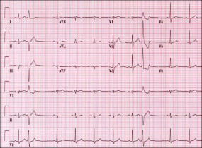 EKG